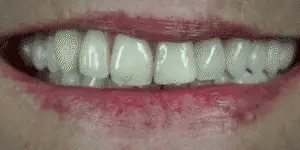 Brilliva - Clip-On Dentali Immediati per Denti Superiori e Inferiori