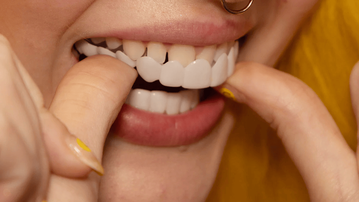 Brilliva - Clip-On Dentali Immediati per Denti Superiori e Inferiori
