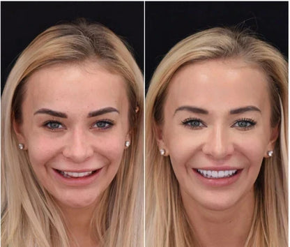 Brilliva - Clip-On Dentali Immediati per Denti Superiori e Inferiori