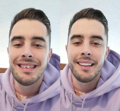 Brilliva - Clip-On Dentali Immediati per Denti Superiori e Inferiori